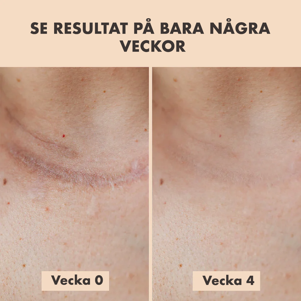 Skinara™ – Silikonplåster