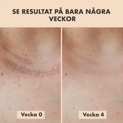 Skinara™ – Silikonplåster